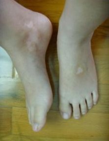 白癜风的症状表现
