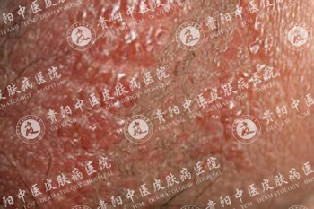 专家解析湿疹症状图
